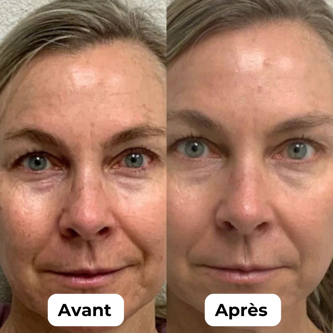 Stylo de Microneedling Pro 7 - Kit complet